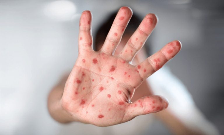 La OMS declaró que la viruela del mono sigue constituyendo una emergencia de salud pública internacional