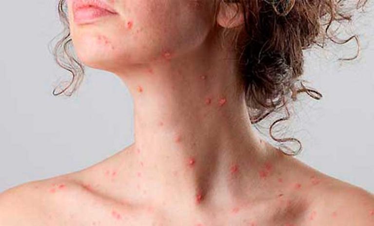 Por qué la vacuna contra el herpes zóster puede reducir el riesgo de desarrollar demencia en mujeres